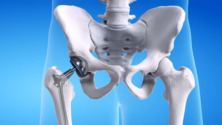Hip-Replacement-Surgery-11