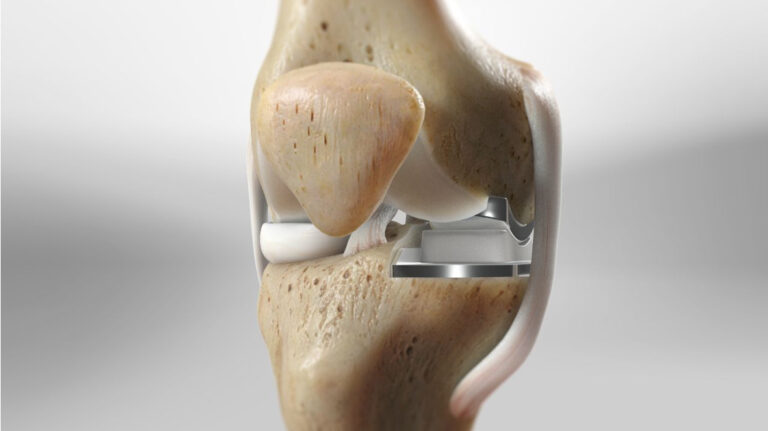 Partial-knee-replacement-11
